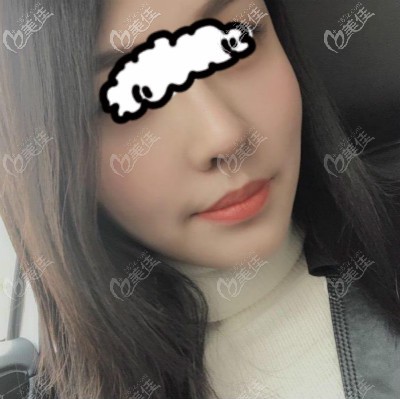 餅臉塌鼻,到武漢亞韓做自體肋骨隆鼻后感覺臉都變小了,3萬真沒白花！