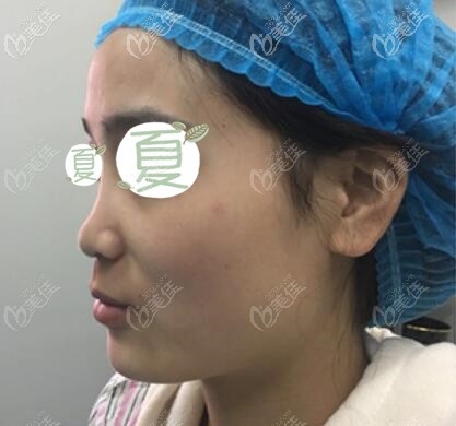 隆鼻術(shù)前照 隆鼻術(shù)前照