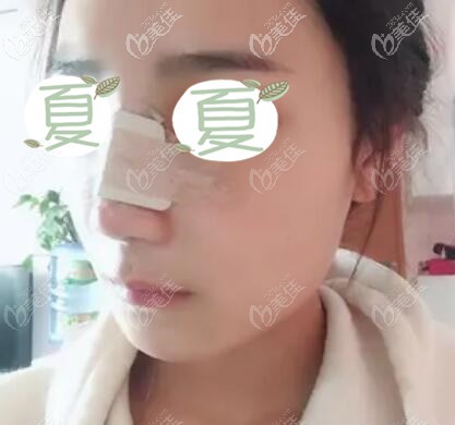 鼻綜合術(shù)后第3天 鼻綜合術(shù)后第3天