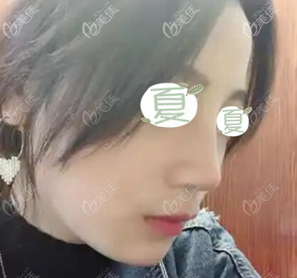 做鼻綜合術(shù)后16天恢復效果 做鼻綜合術(shù)后16天恢復效果