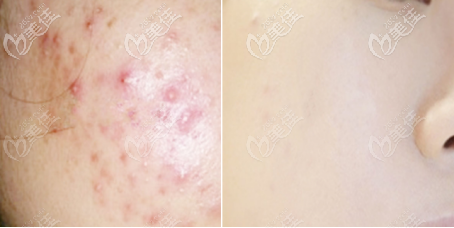點(diǎn)陣激光祛痘術(shù)前術(shù)后對(duì)比圖