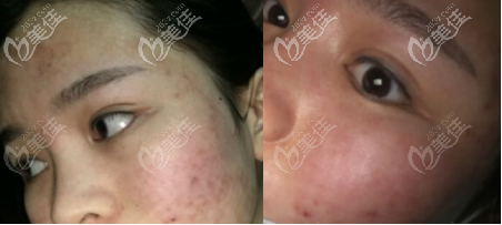 點(diǎn)陣激光祛痘術(shù)前術(shù)后對(duì)比圖