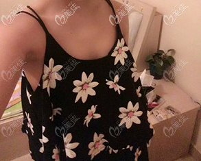 <!--<i data=20240703-sp></i>-->自體脂肪豐胸術(shù)前照片 <!--<i data=20240703-sp></i>-->自體脂肪豐胸術(shù)前照片