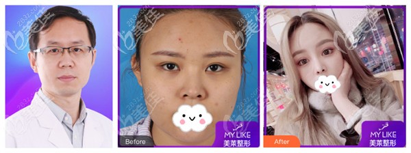 于雙全醫(yī)生做肋軟骨隆鼻案例