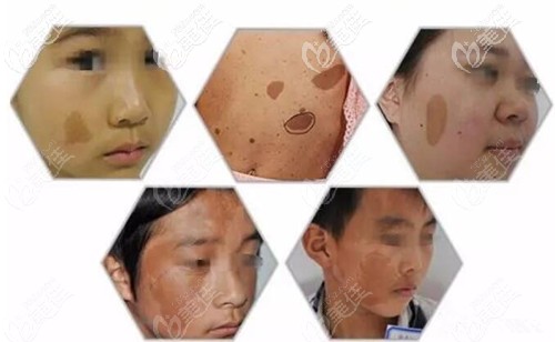 各種咖啡斑 各種咖啡斑