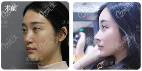 北京隆鼻手術(shù)多少錢一次？我花7萬多找北京沃爾劉彥軍隆鼻案例效果參考