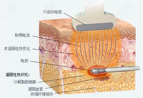 射頻溶脂瘦臉原理 射頻溶脂瘦臉原理