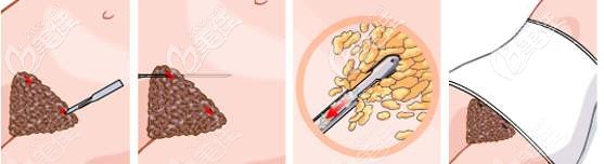 腰腹吸脂手術(shù)過(guò)程 腰腹吸脂手術(shù)過(guò)程