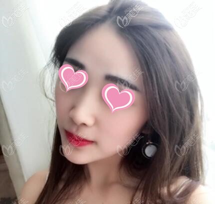 玻尿酸墊下巴半個(gè)月效果照 玻尿酸墊下巴半個(gè)月效果照