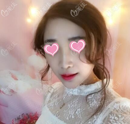 伊婉玻尿酸墊下巴術(shù)后1個(gè)月效果照 伊婉玻尿酸墊下巴術(shù)后1個(gè)月效果照