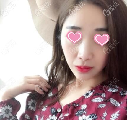 瞧我在長沙美萊花了不到3000元打的伊婉V玻尿酸豐下巴效果不錯吧，總共用了1ml！