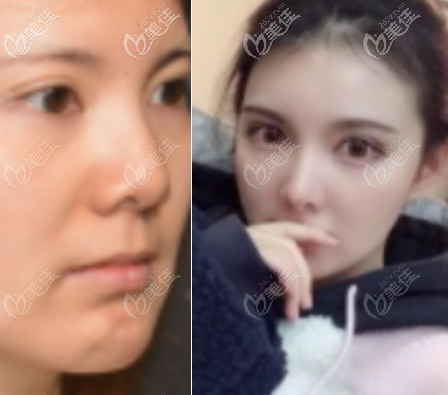 李勁良鼻小柱延長手術(shù)恢復(fù)30天的術(shù)前術(shù)后對比圖