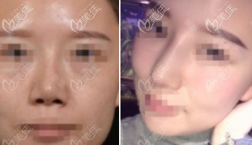 李勁良醫(yī)生做鼻小柱延長手術(shù)的案例