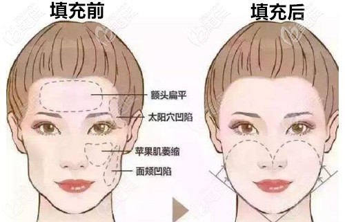 采用脂肪膠填充面部術(shù)前術(shù)后詳細(xì)對(duì)比