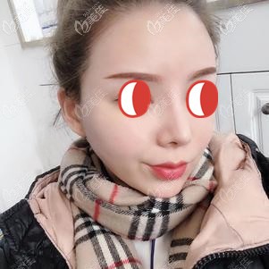 二次補(bǔ)膠后顧客面部自然飽滿