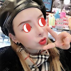 初次填充術(shù)后48天臉頰輕微凹陷