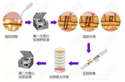提取脂肪膠的手術(shù)示意圖
