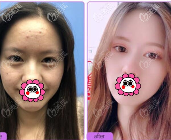 寧波美萊鄭景芳雙眼皮案例