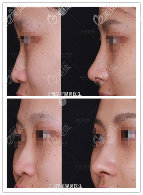 劉彥軍初鼻效果