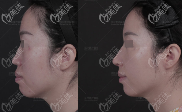 北京沃爾肋軟骨隆鼻案例