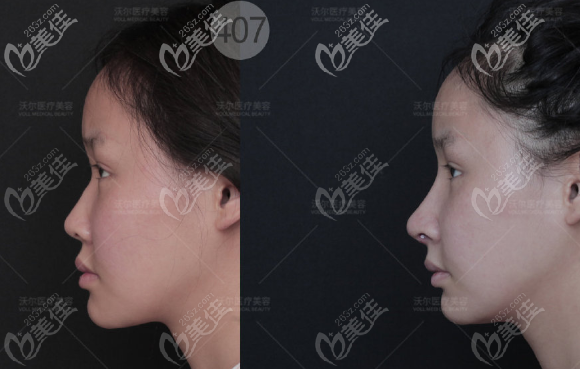 劉彥軍膨體鼻綜合案例