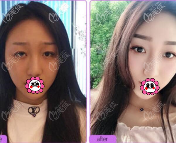 寧波美萊孫明磊鼻綜合案例