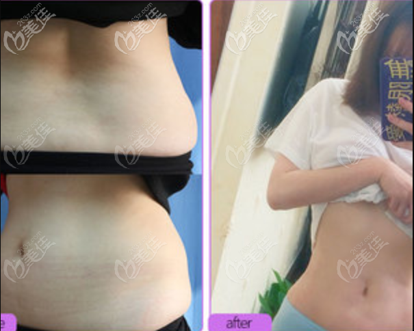 寧波美萊姚遠(yuǎn)腰腹吸脂案例