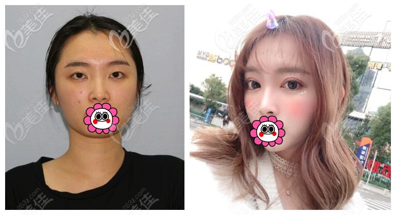 寧波薇琳雷艷莉雙眼皮案例