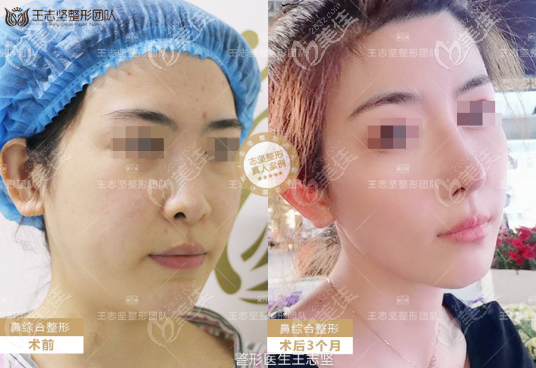 北京京民醫(yī)院鼻綜合案例