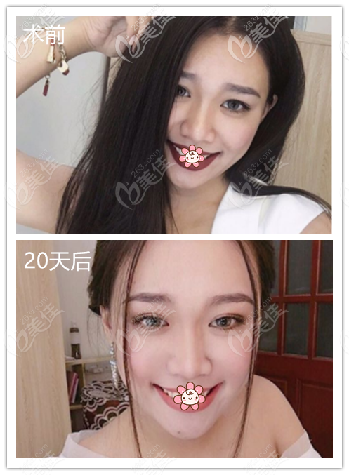 熱瑪吉去法令紋術前術后效果圖對比 熱瑪吉去法令紋術前術后效果圖對比