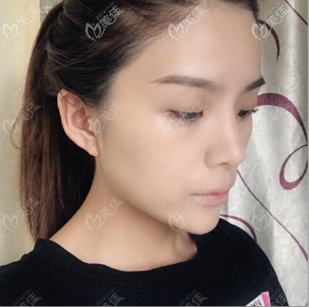 聽(tīng)說(shuō)深圳鵬程醫(yī)院雙眼皮陳俊合醫(yī)生做的好 聽(tīng)說(shuō)深圳鵬程醫(yī)院雙眼皮陳俊合醫(yī)生做的好