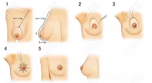 乳房塑形懸吊術(shù)示意圖