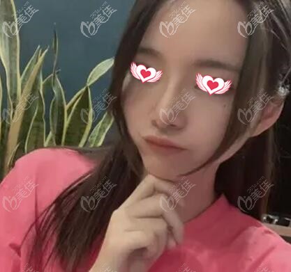 注射瘦臉術(shù)后1周照 注射瘦臉術(shù)后1周照