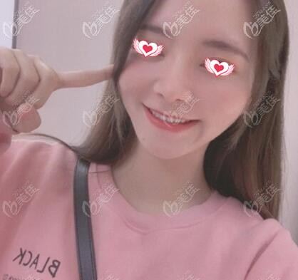 注射瘦臉術(shù)后半個月效果照 注射瘦臉術(shù)后半個月效果照