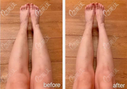 脂肪型小腿抽脂術(shù)前術(shù)后樣子