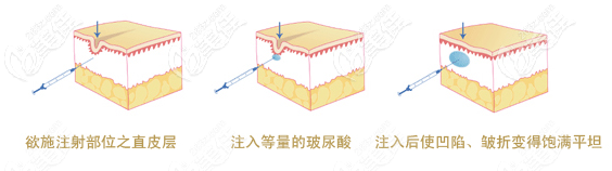 玻尿酸填充原理