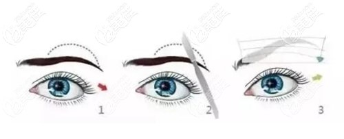 提眉手術過程 提眉手術過程