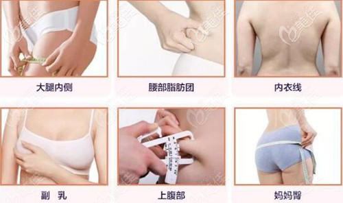 酷塑溶脂可以解決的部位