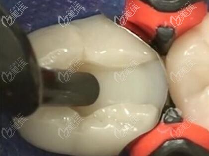 牙齒缺損充填治療 牙齒缺損充填治療