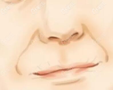 鼻唇溝也叫法令紋