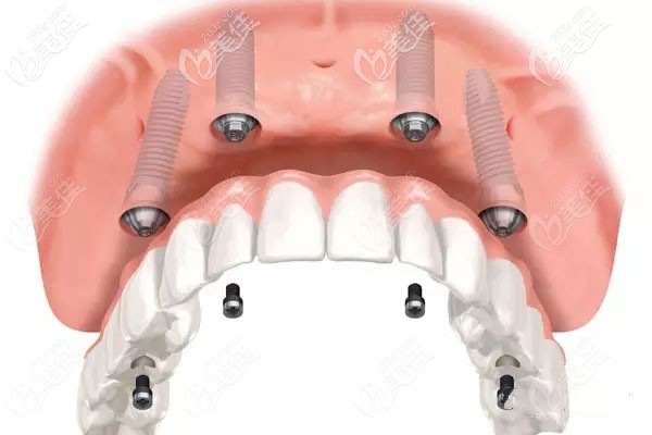 全口all-on-4種植牙的價格需要10萬元嗎