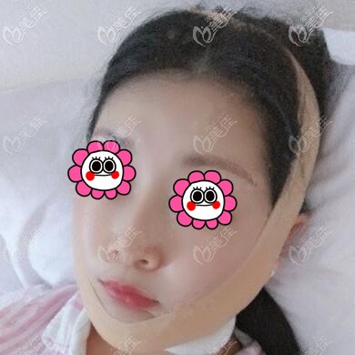 下頜緣吸脂術后當天