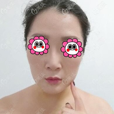 下頜緣吸脂術后6天效果