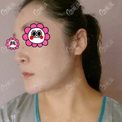 下頜緣吸脂術后20天效果照