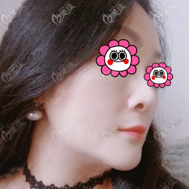 雙下巴吸脂術后32天效果照