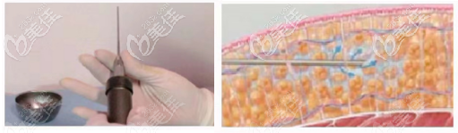 北京米蘭柏羽麗都25度低溫吸脂手術(shù)過程示意圖