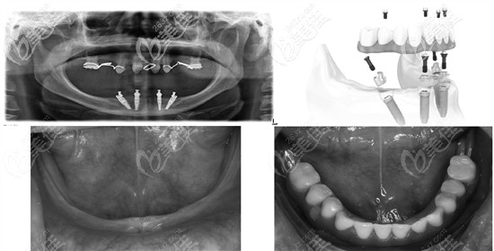allon4全口種植牙技術