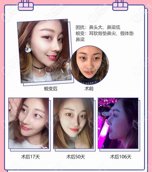 南京曹海峰做鼻子案例 南京曹海峰做鼻子案例