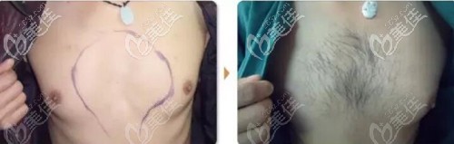 胸毛種植前后效果對比
