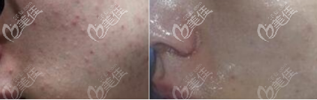 點(diǎn)陣激光祛坑術(shù)前術(shù)后對(duì)比照